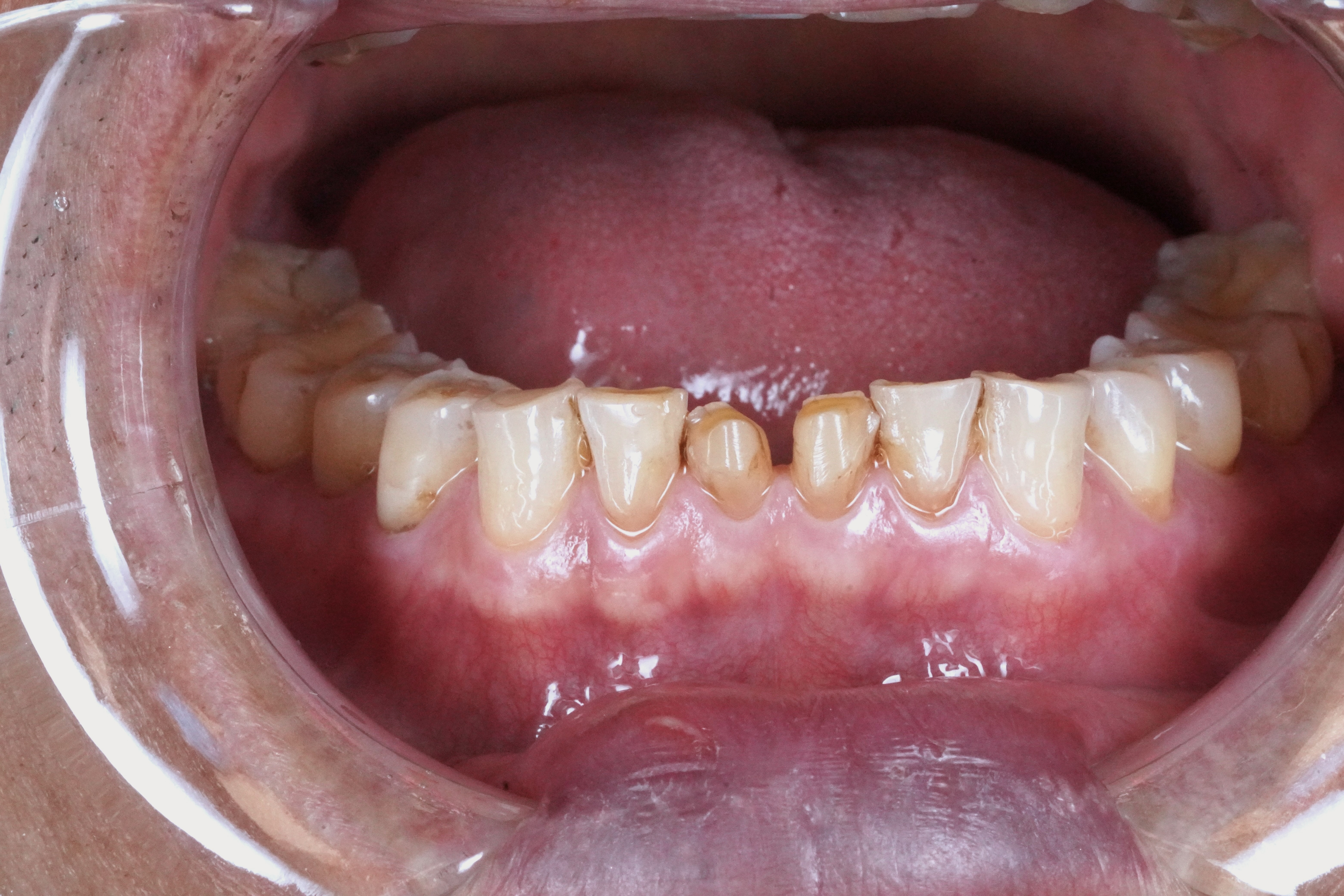 Before treatment